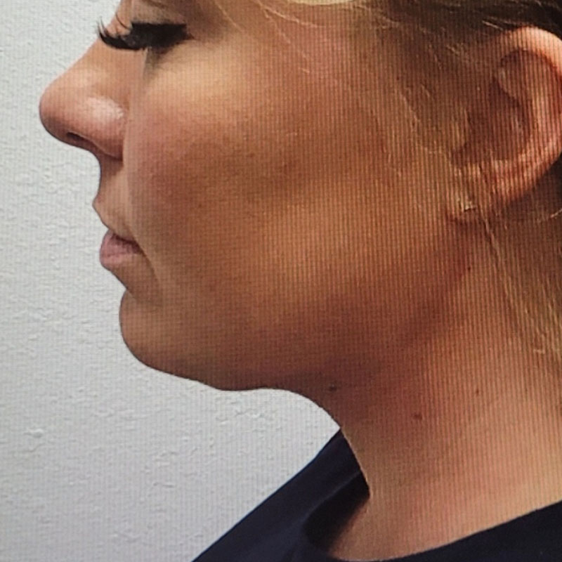 Facetite before & after photo