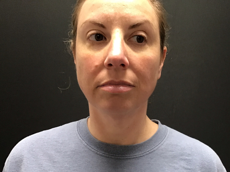 Facetite before & after photo