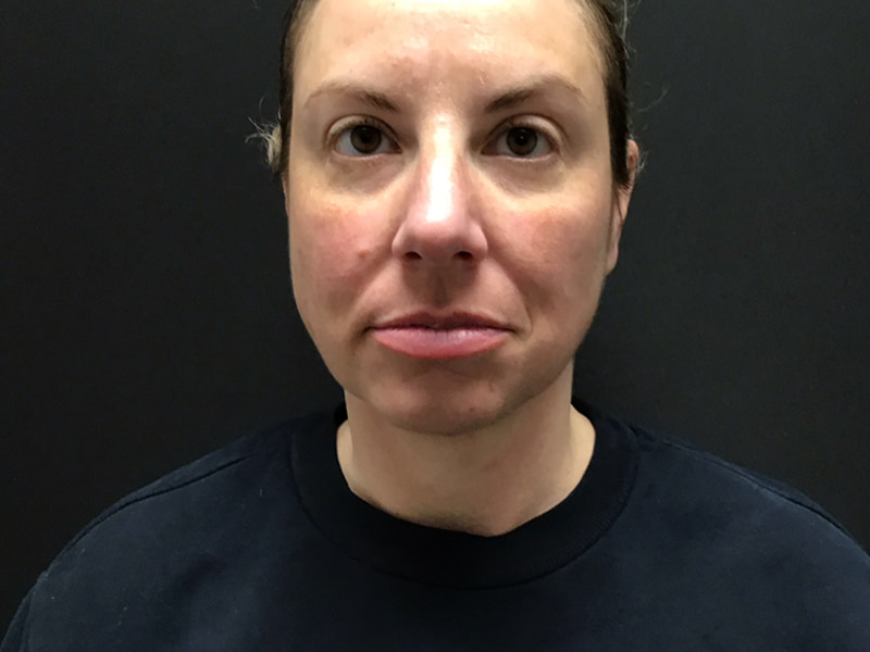 Facetite before & after photo