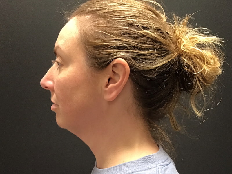 Facetite before & after photo