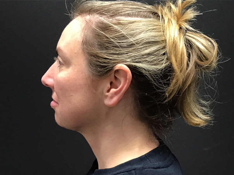 Facetite before & after photo