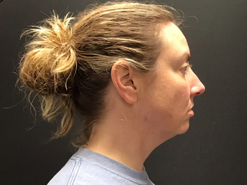 Facetite before & after photo