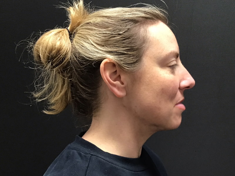 Facetite before & after photo