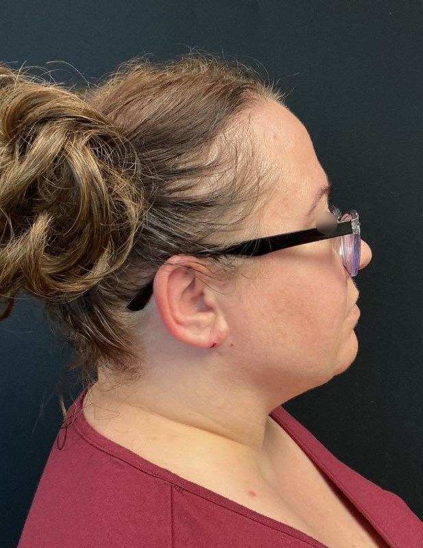 Facetite before & after photo