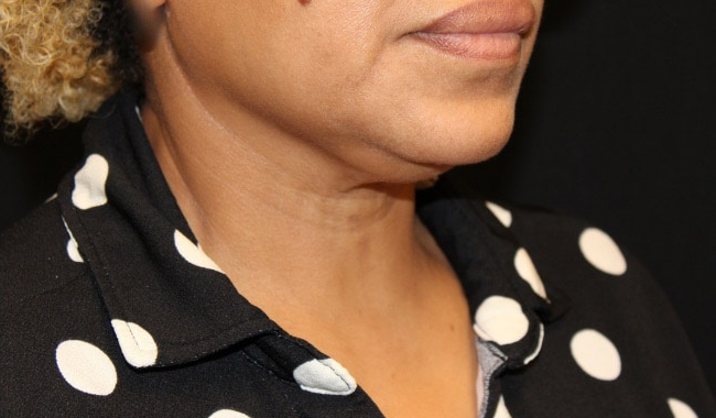 Facetite before & after photo