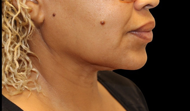 Facetite before & after photo