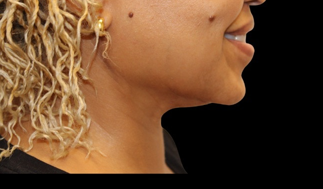 Facetite before & after photo