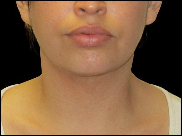 Facetite before & after photo