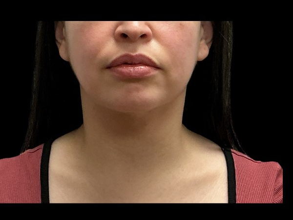 Facetite before & after photo