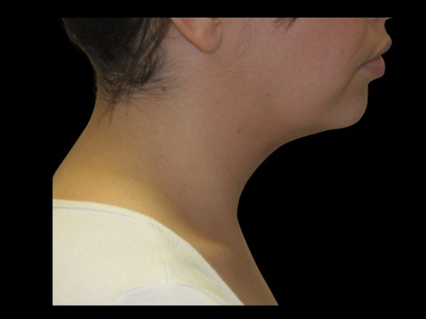 Facetite before & after photo
