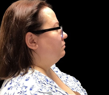 Facetite before & after photo