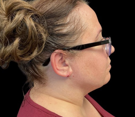 Facetite before & after photo