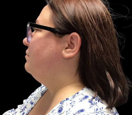 Facetite before & after photo