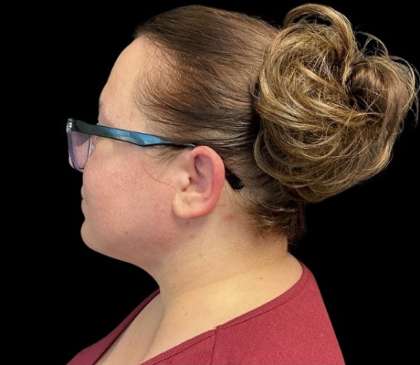 Facetite before & after photo