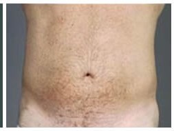 Vaserlipo before & after photo