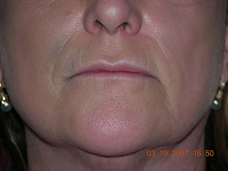 Juvederm before & after photo