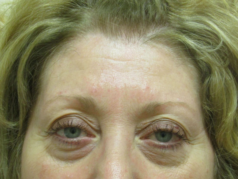 Juvederm before & after photo