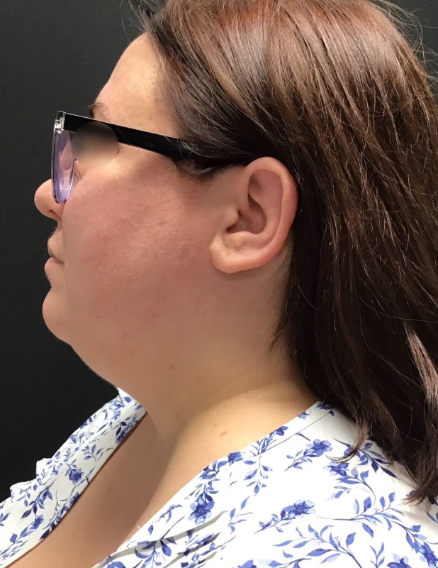 Facetite before & after photo