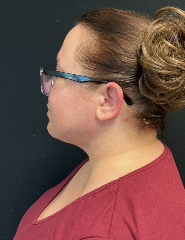 Facetite before & after photo