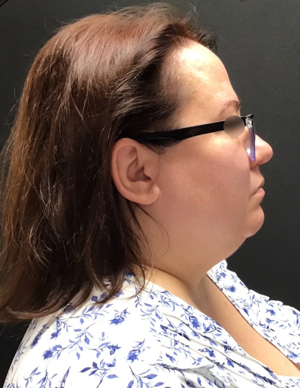 Facetite before & after photo