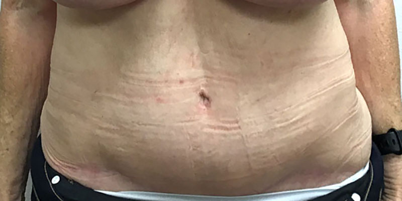 Wwl before & after photo