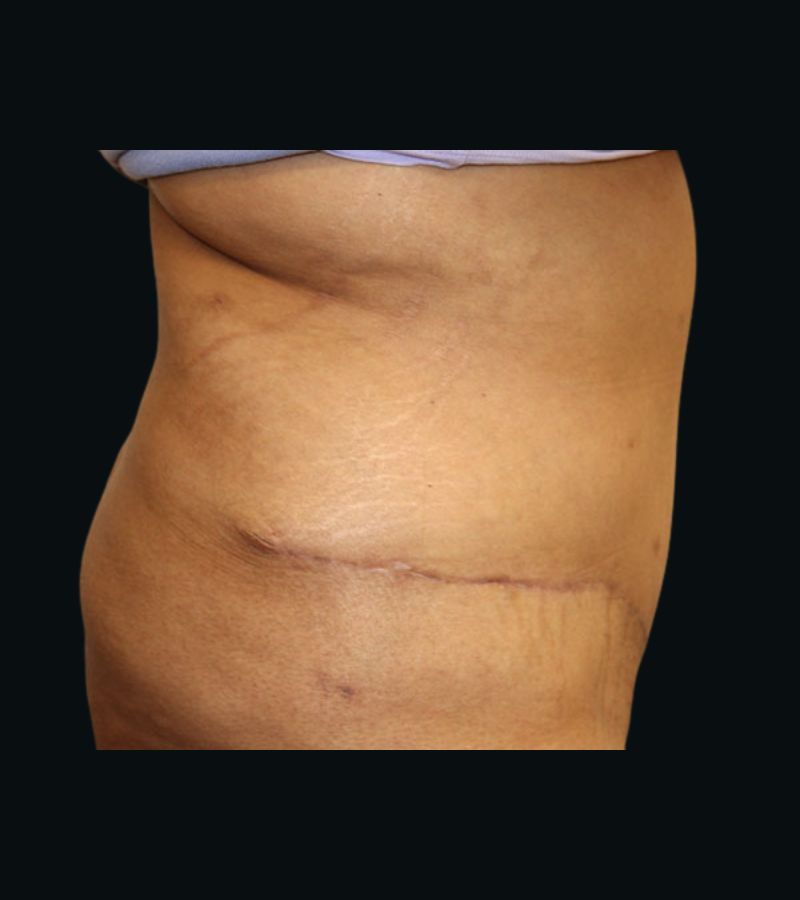 Wwl before & after photo