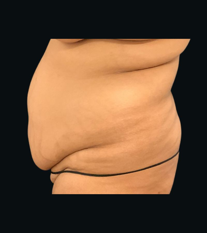 Wwl before & after photo