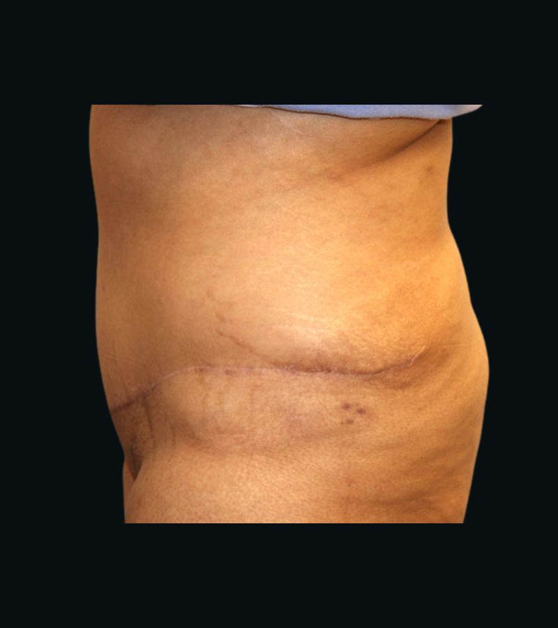 Wwl before & after photo