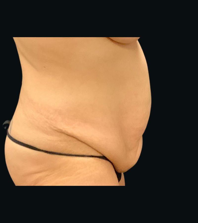 Wwl before & after photo