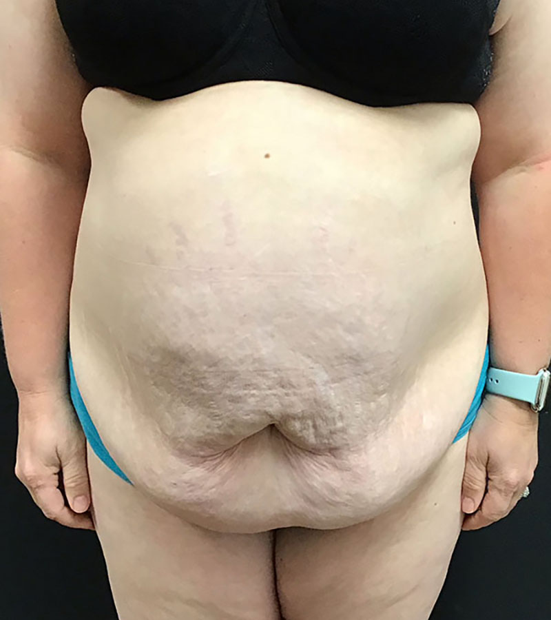 Wwl before & after photo