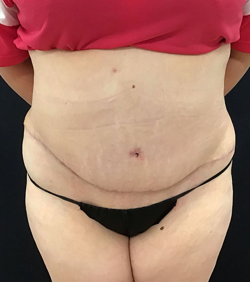 Wwl before & after photo