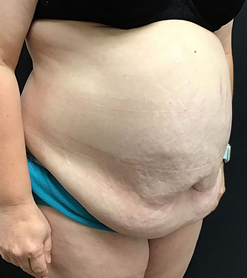 Wwl before & after photo