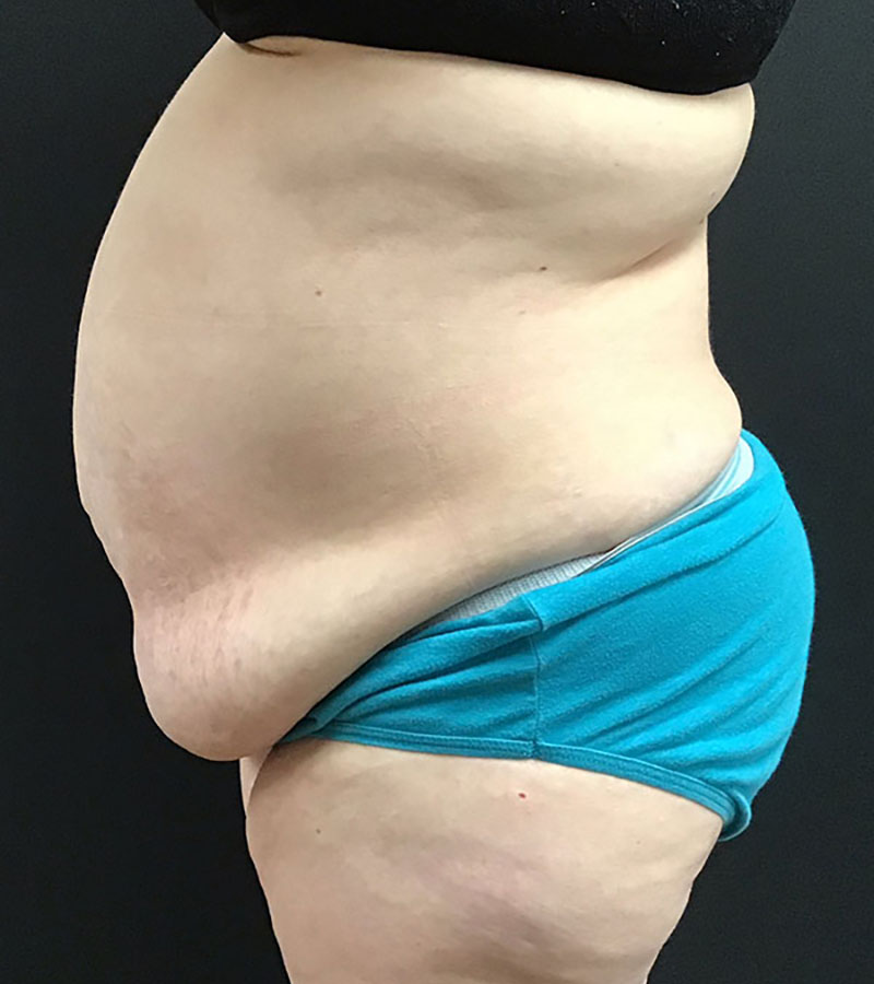 Wwl before & after photo