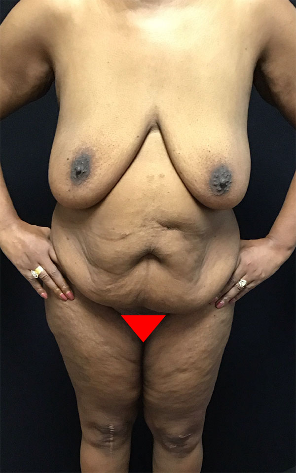 Wwl before & after photo