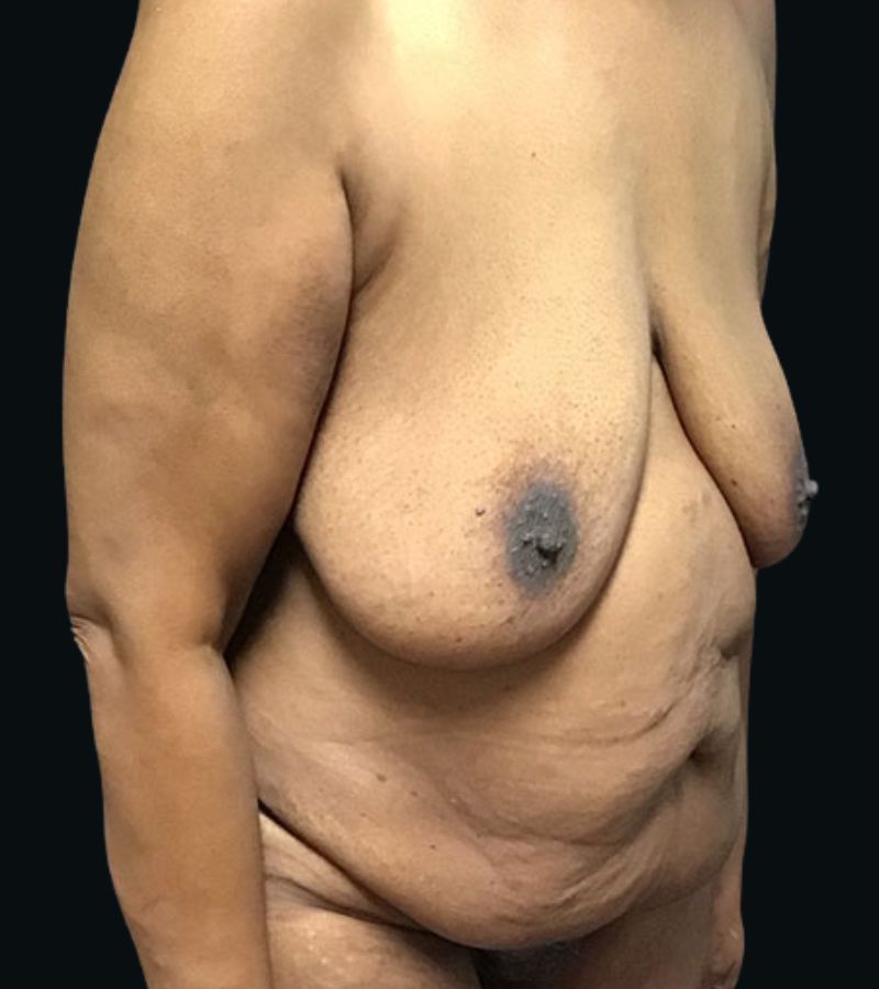 Wwl before & after photo